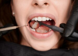 Caries dental señales tempranas, tratamiento