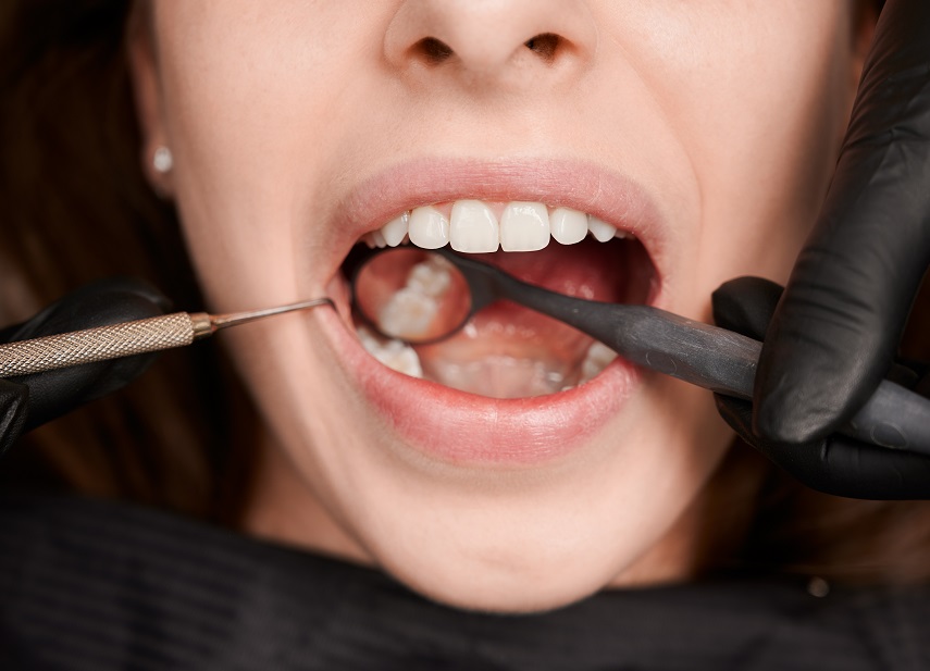 Caries dental señales tempranas, tratamiento
