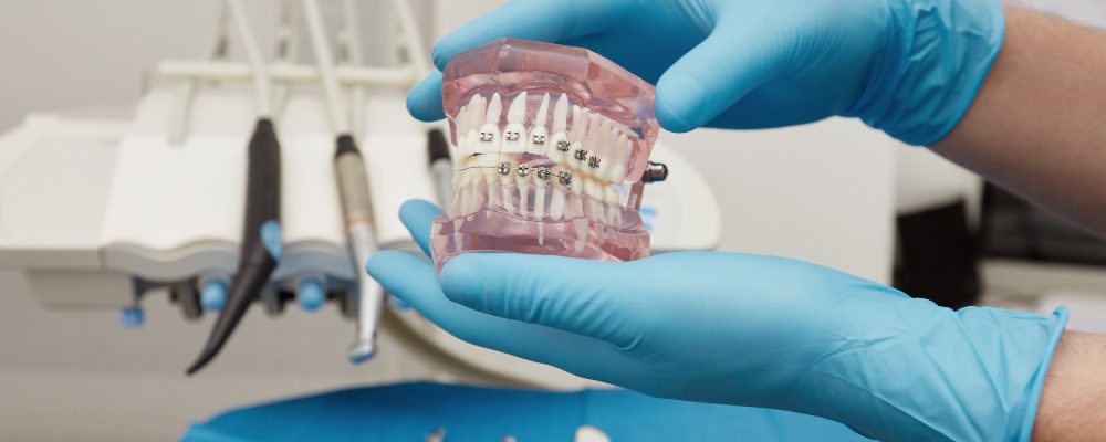 muestra de maqueta de brackets metales